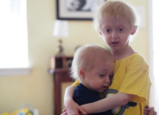Cảm động câu chuyện hai anh em mắc bệnh lão hóa sớm - Nathan và Bennett