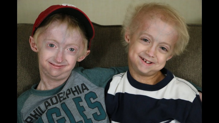 Cảm động câu chuyện hai anh em mắc bệnh lão hóa sớm - Nathan và Bennett 